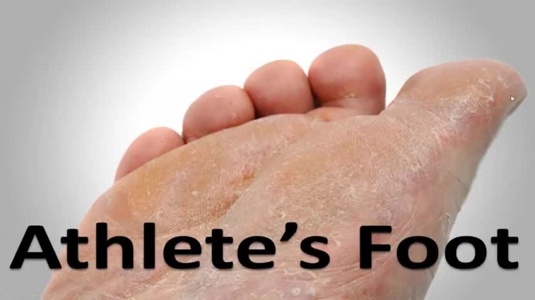 ⁣Athlete's Foot Fungus Cure in 3 Minutes! **Simple Home Trick**