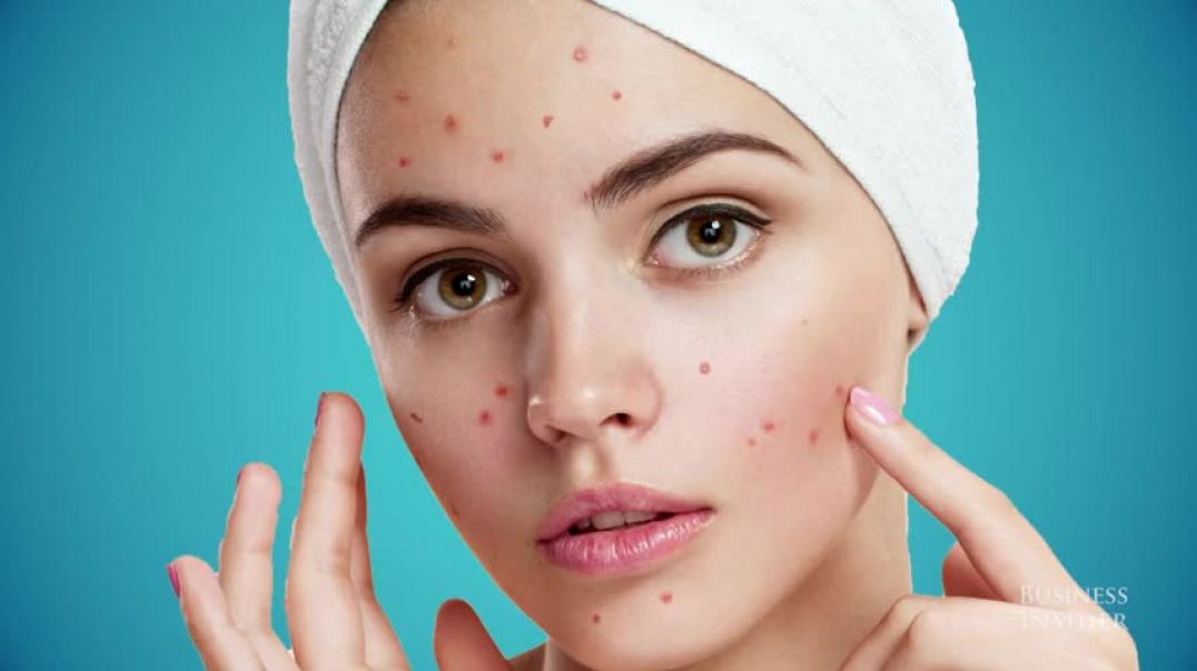 ⁣Why You Shouldn't Pop Your Pimples | Science Insider