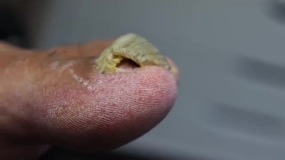 ⁣DAMAGED THICK TOENAIL HAS NOW GROWN INTO A TOENAIL TUNNEL!!!
