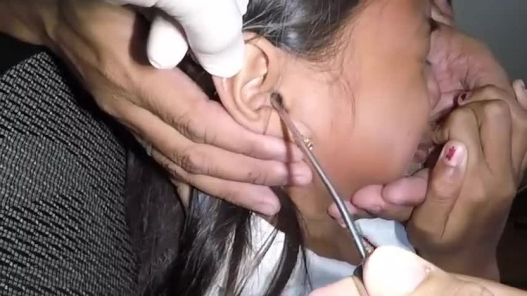 Removing Something Trapped in Girl's Ear . It's STUCK!
